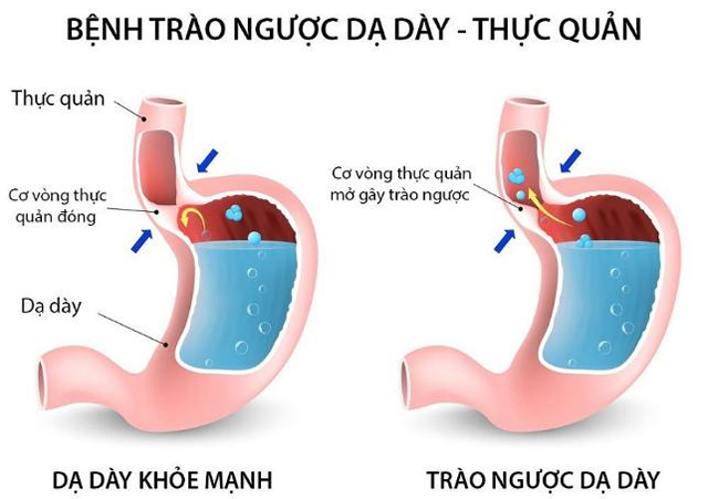 5 tác dụng phụ bất ngờ của bơ đậu phộng, cần biết để tránh rủi ro - Ảnh 1